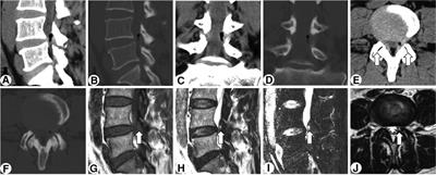 A rare gas-containing lumbar synovial cyst treated by percutaneous transforaminal endoscopic cystectomy: A case report and literature review